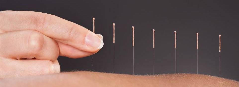 acupuncture
